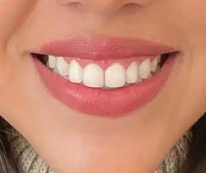 diente alineados con ortodoncia