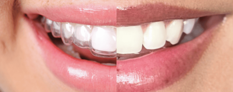 Wire Aligner vs. Invisalign: ¿Cuál es Realmente Invisible?