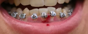 Encías inflamadas por brackets