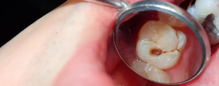 dientes con caries y brackets