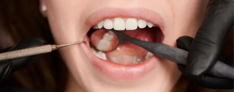 extracción de muela del juicio precio