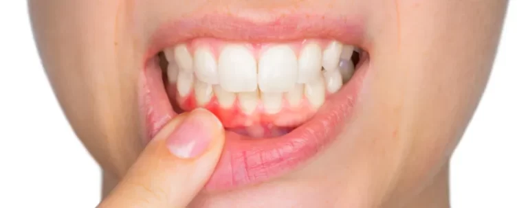 encias inflamadas que tomar