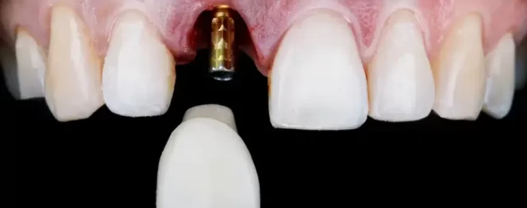 ortodoncia con corona