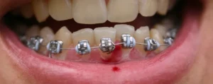 heridas en la boca por brackets