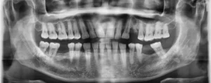 radiografía panorámica dental