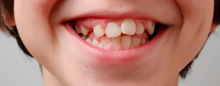 protusión dental qué es