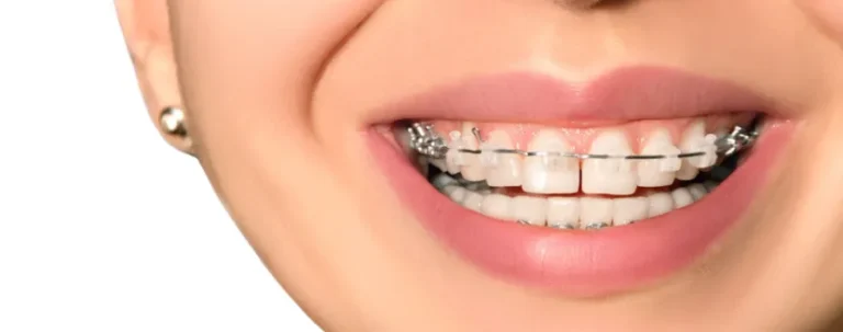 bracket-transparentes-de-zafiro