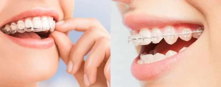 ortodoncia y bracket