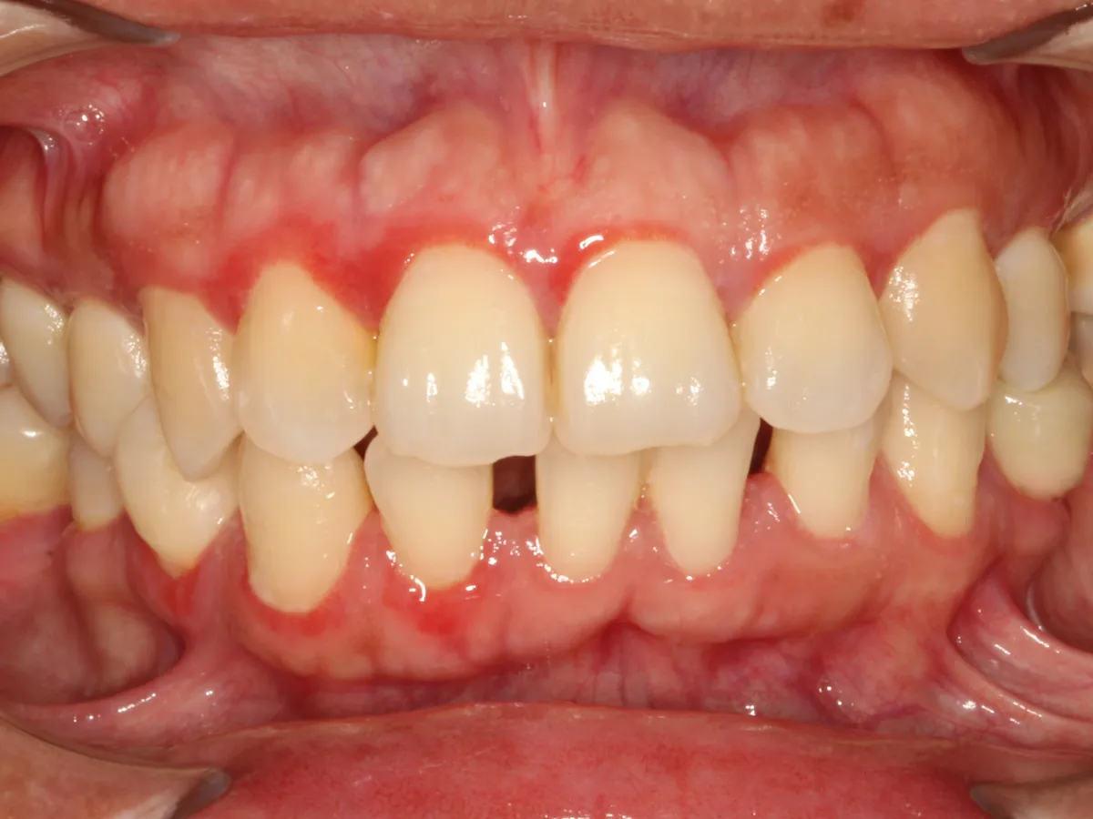 Diastemas múltiples con espacios visibles entre varios dientes