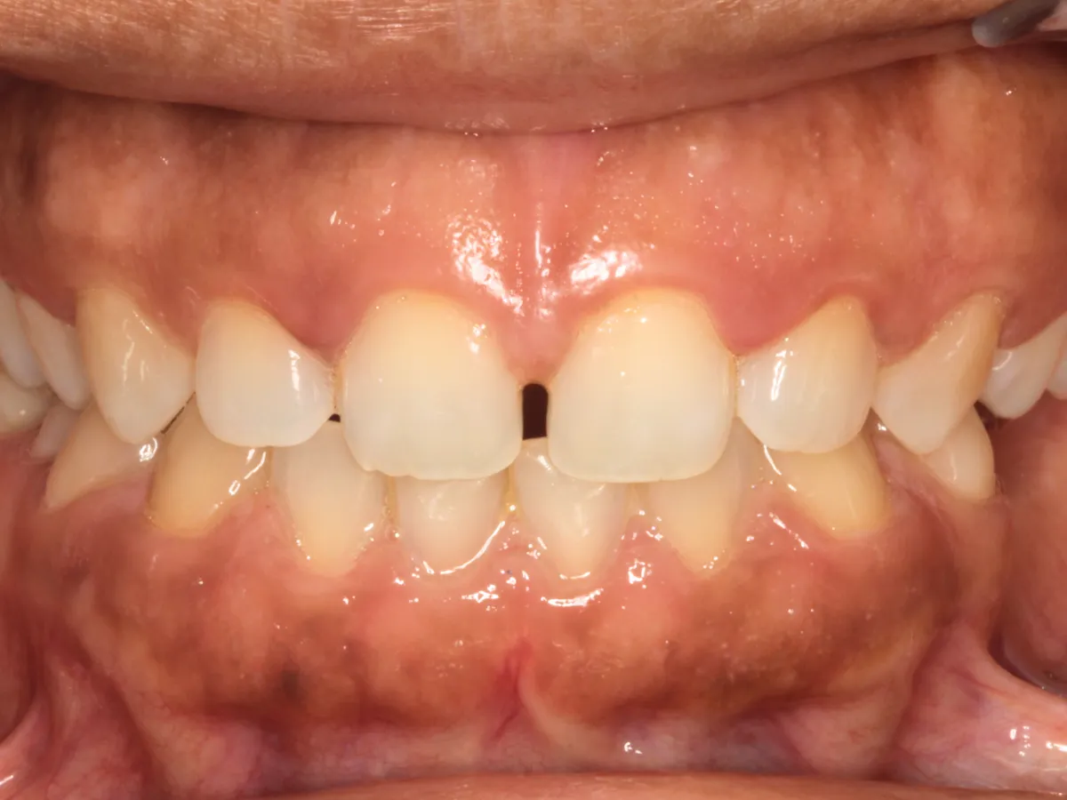 Diastema causado por diferencia en el tamaño de los dientes