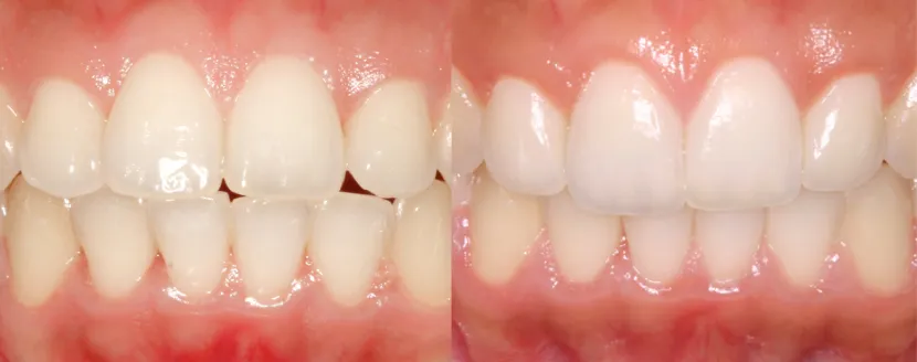 personas-con-bracket