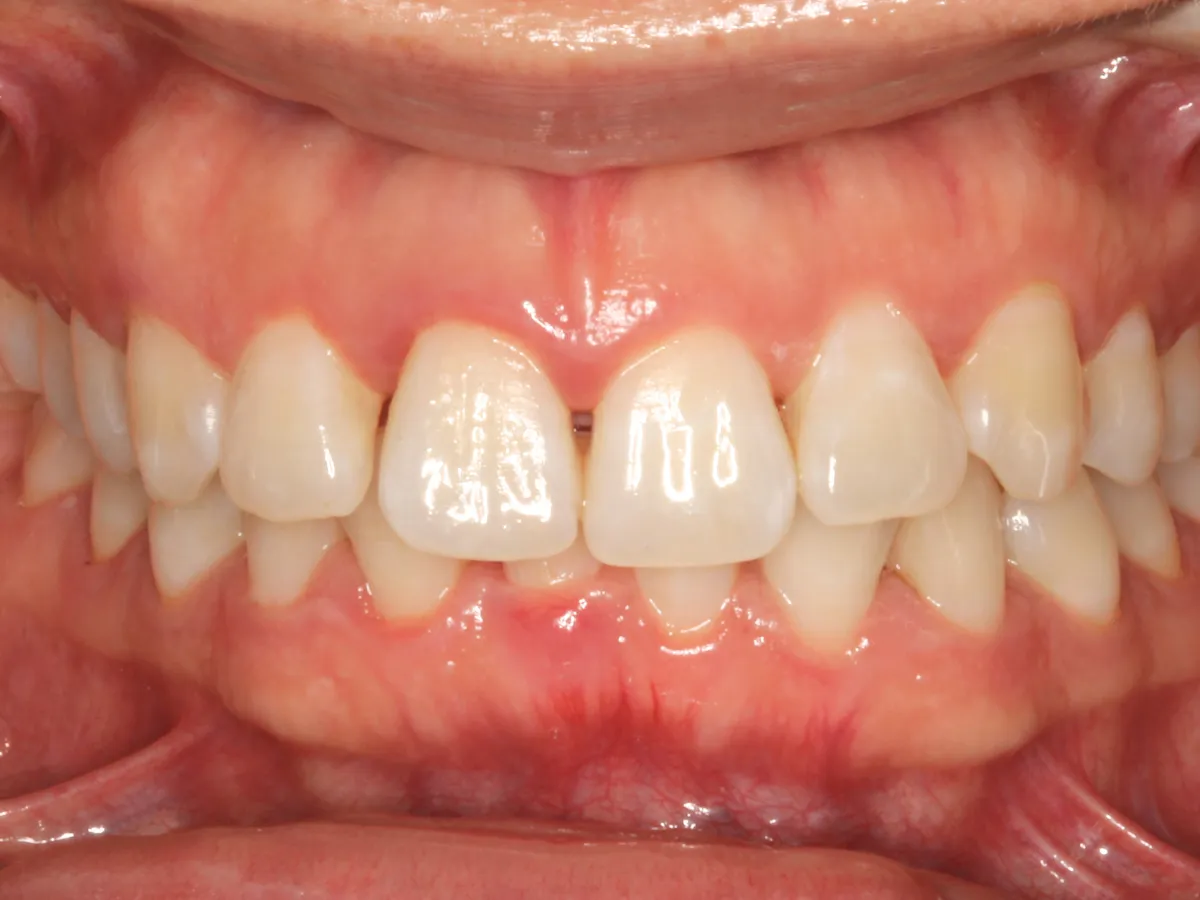 Diastema antes del tratamiento con wire aligner