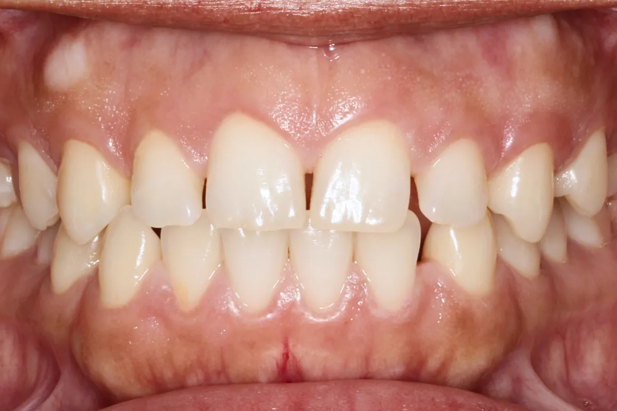 Sonrisa con diastema, espacio entre los dientes delanteros