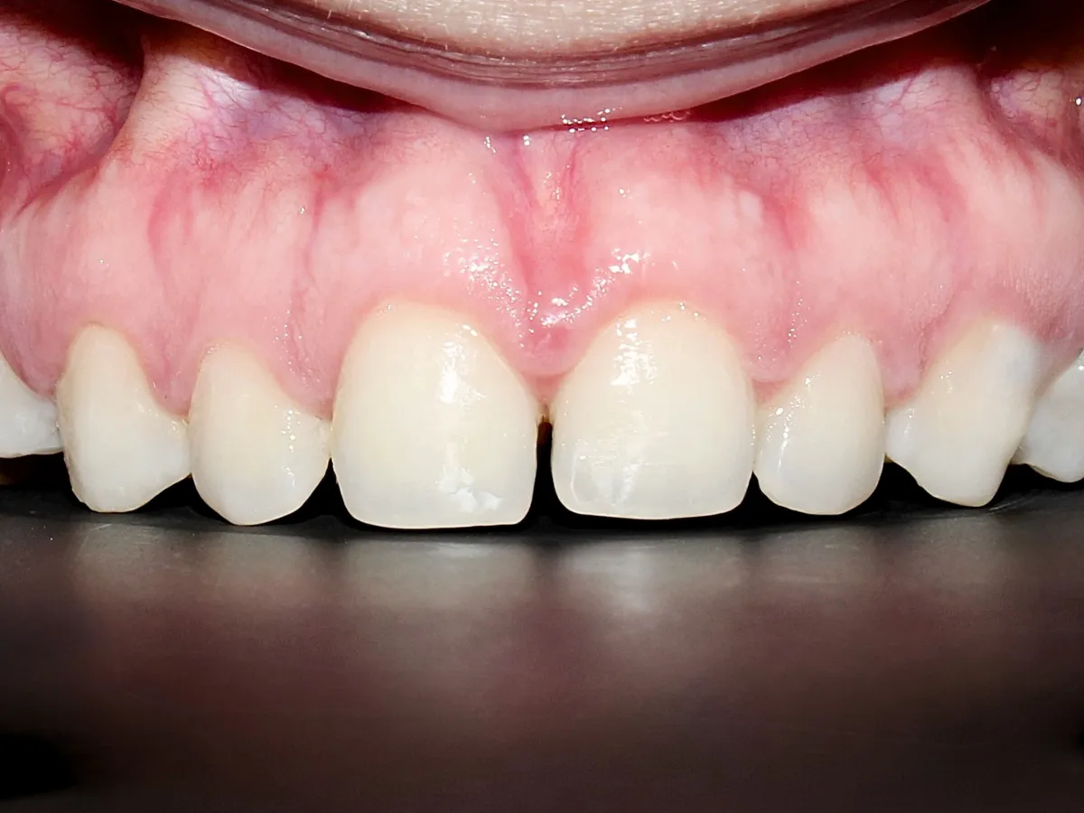 Diastema frontal con separación entre los dientes incisivos delanteros