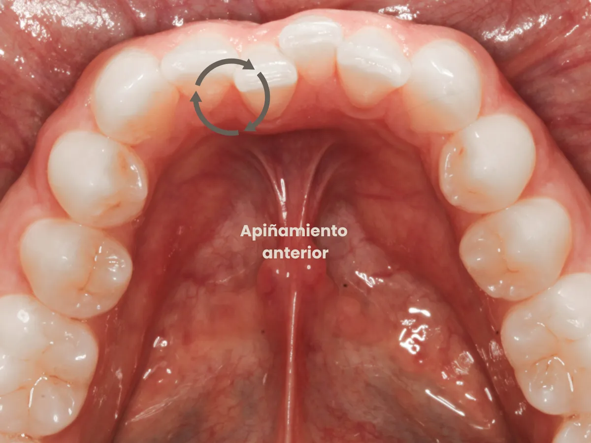 Apiñamiento dental en dientes frontales con desalineación visible