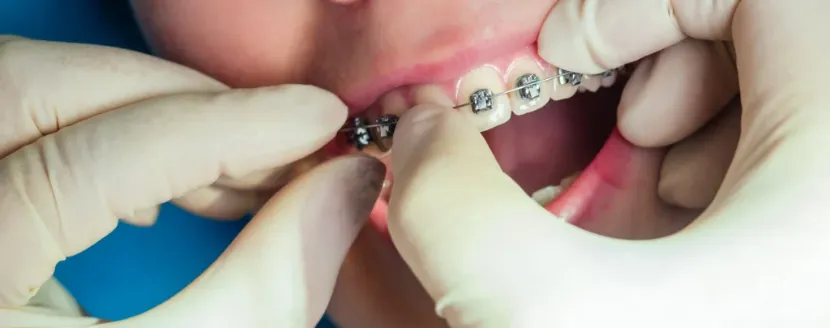 brackets-falsos-y-sus-consecuencias-en-salud-dental