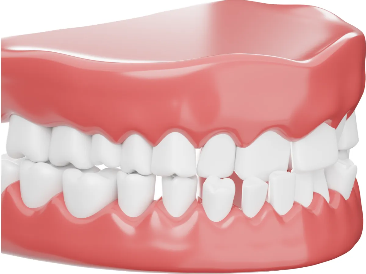 Ejemplo de mordida cruzada anterior donde los dientes inferiores se posicionan delante de los superiores