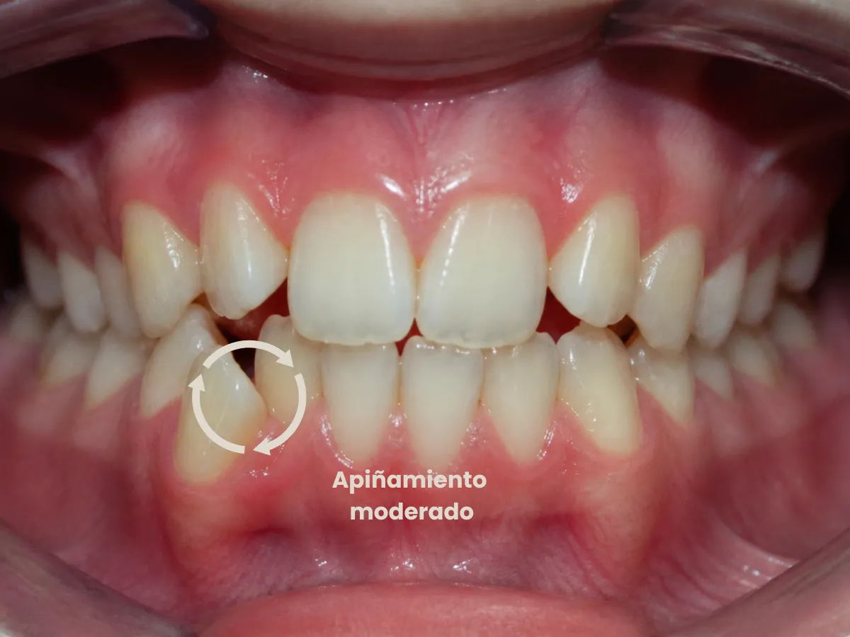 Apiñamiento dental moderado con dientes visiblemente desalineados