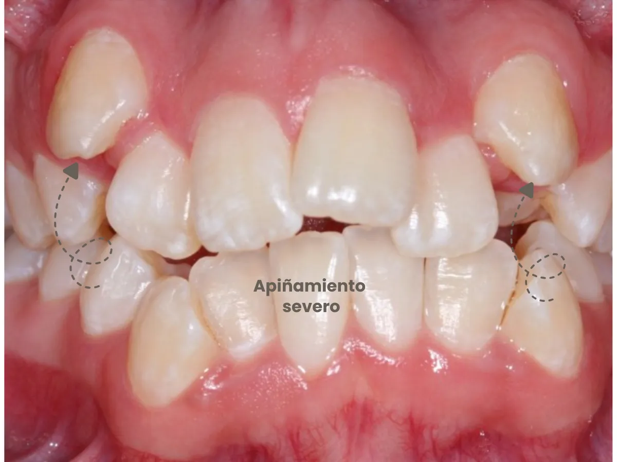 Apiñamiento dental severo con dientes muy superpuestos y falta de espacio