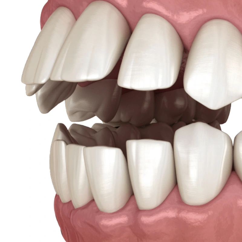 Causas de la sobremordida como factores genéticos, crecimiento irregular de la mandíbula y hábitos dentales