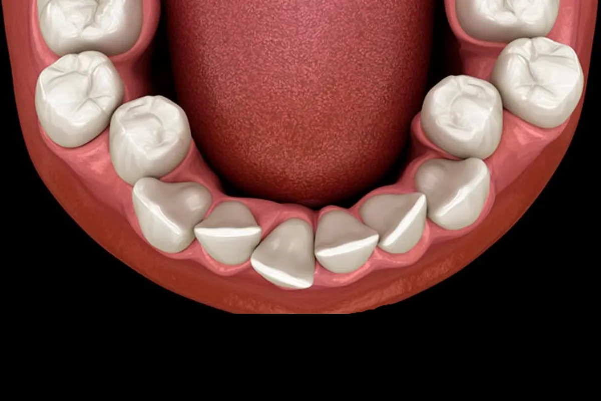Alineadores invisibles corrigiendo dientes girados de forma discreta y estética