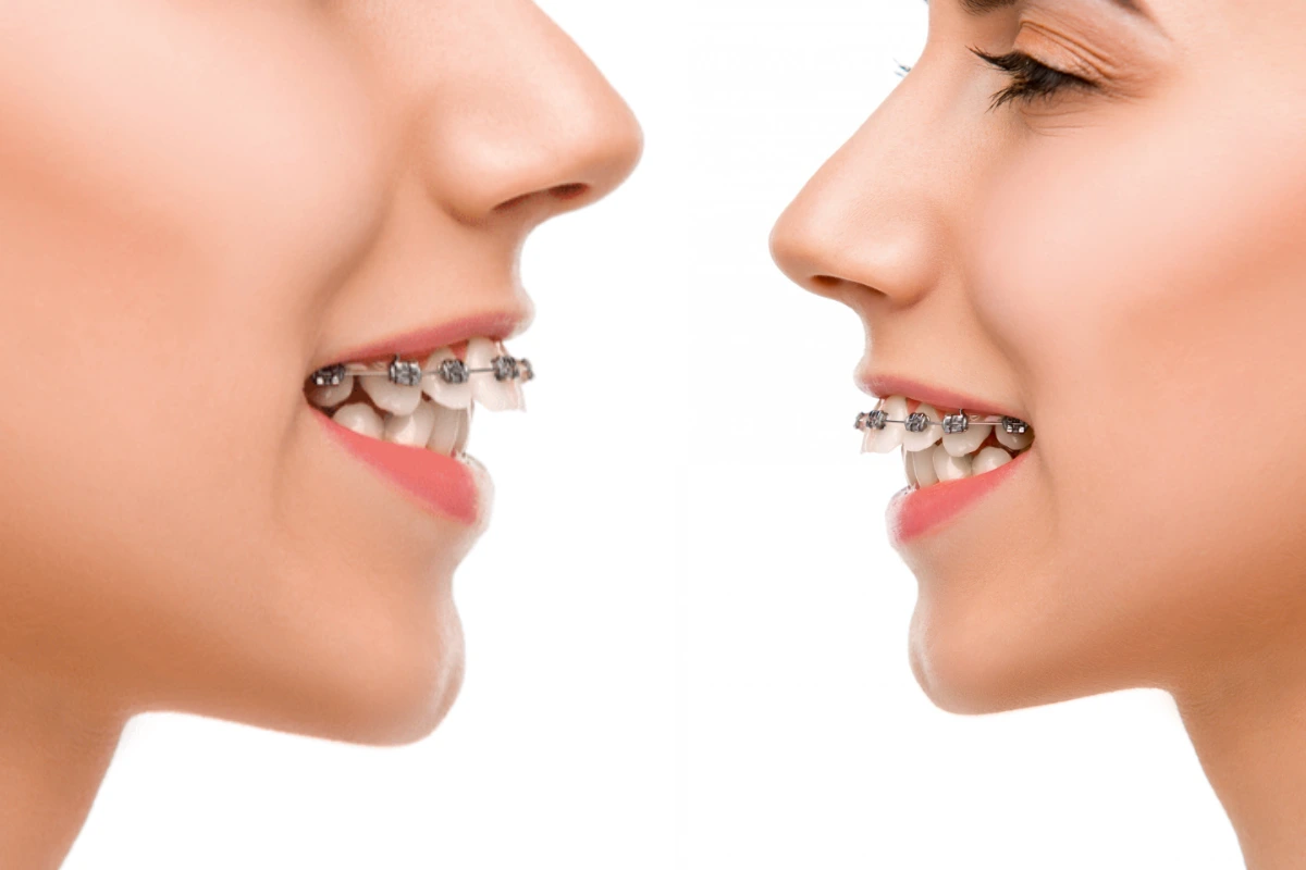 Tratamiento de sobremordida con alineadores invisibles sin brackets