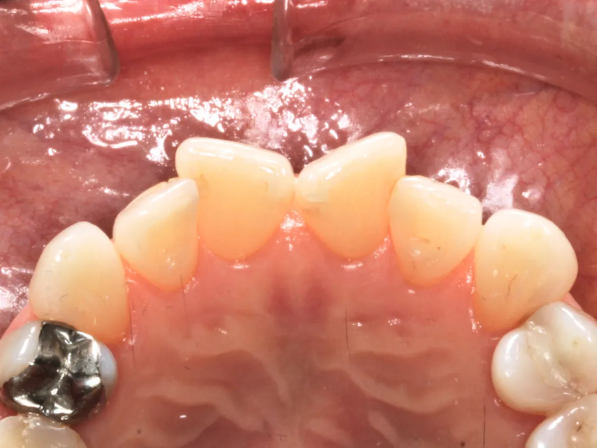 Diente frontal girado visible al sonreír, afecta la estética dental