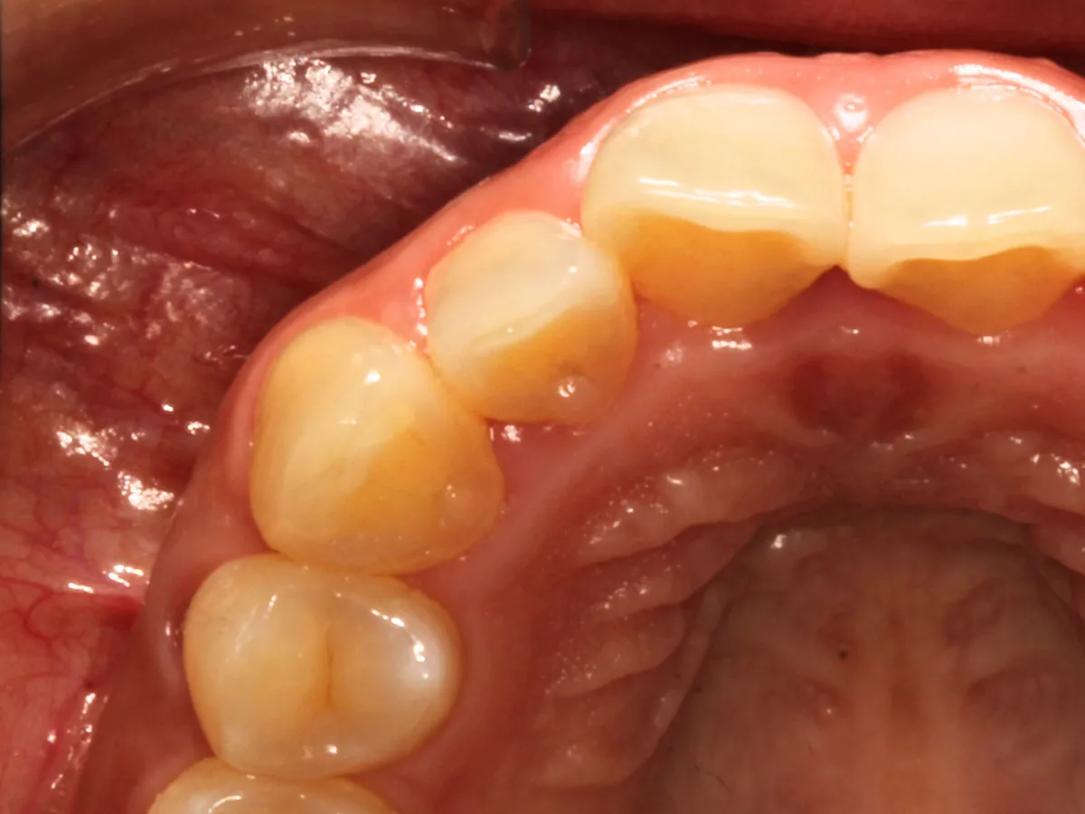 Diente posterior girado en zona trasera, rotación dental menos visible
