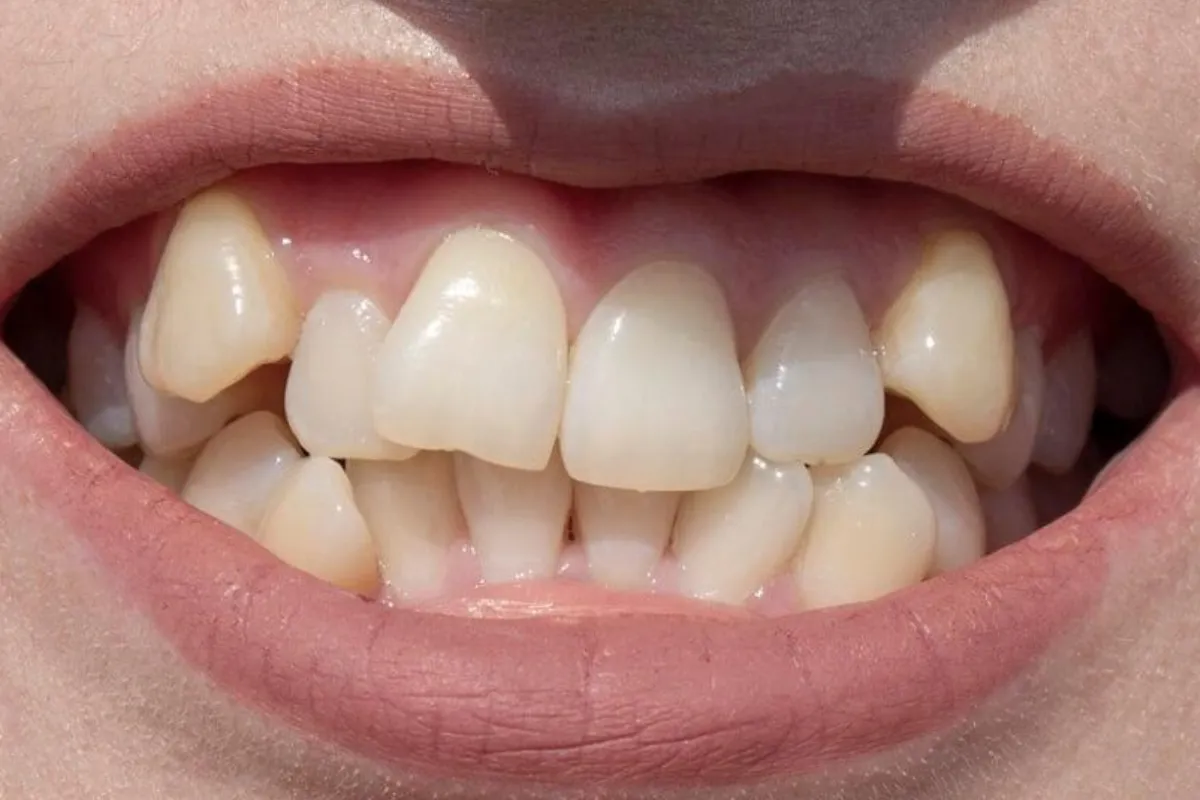 Dientes apiñados con desalineación dental antes de tratamiento