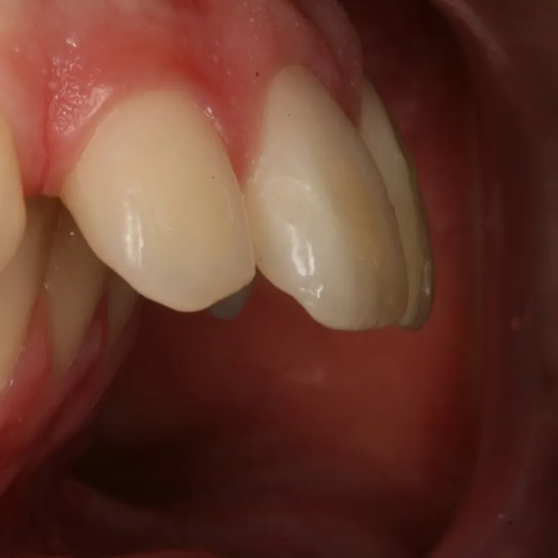 Falta de espacio dental que provoca dientes girados y desalineación en la sonrisa