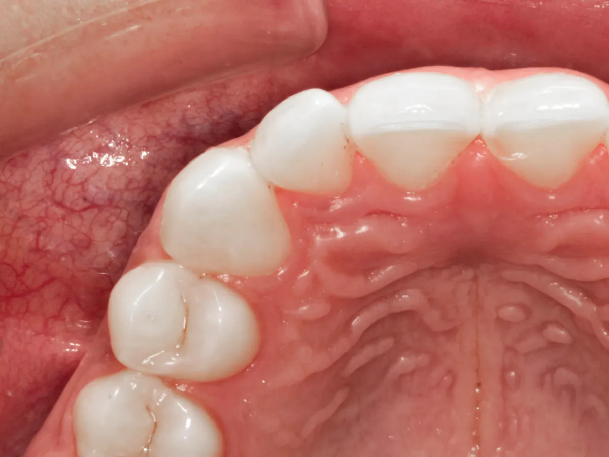 Dientes girados con leve rotación dental, caso leve de alineación irregular