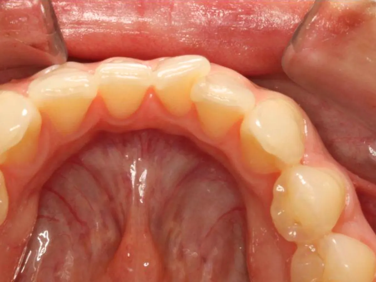 Dientes girados con rotación moderada, desalineación visible en la sonrisa