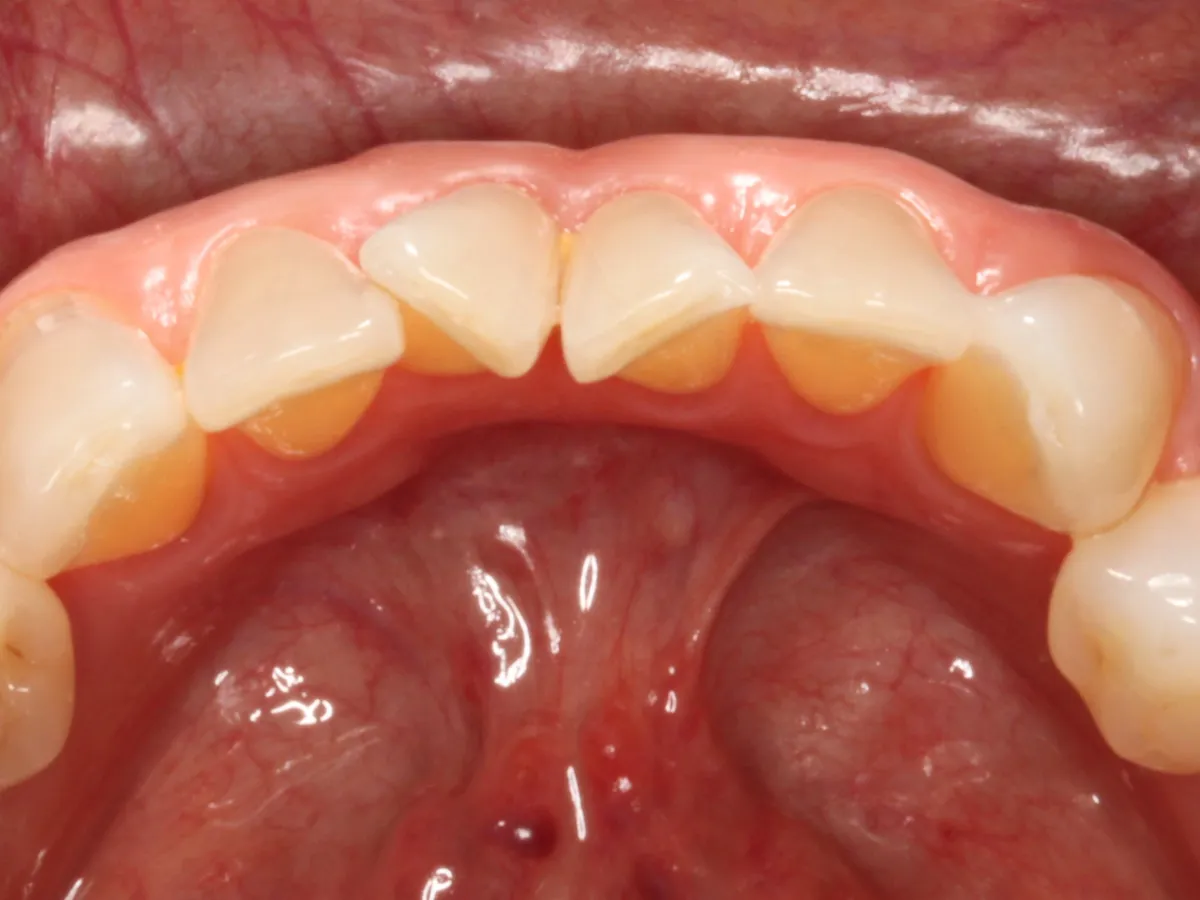 Dientes girados con rotación severa, apiñamiento y desorden dental marcado
