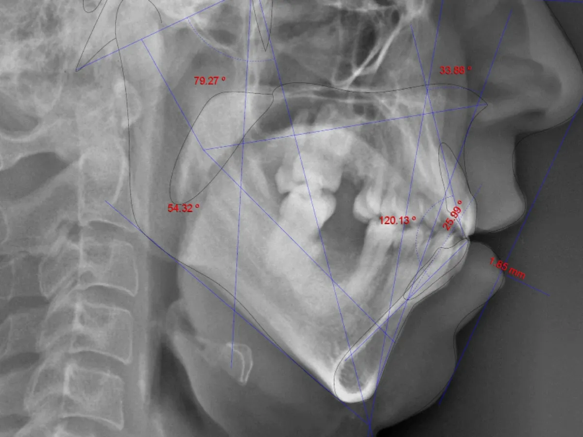 Protursion Wire Tratamiento para protrusión dental o diente de conejo |Wire Aligner