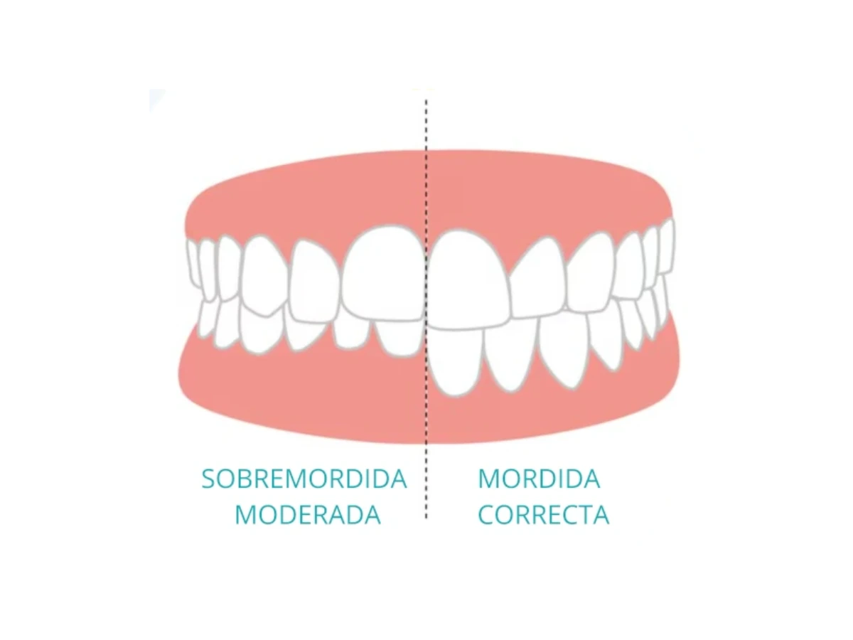 Ejemplo de sobremordida dental donde los dientes superiores cubren los inferiores