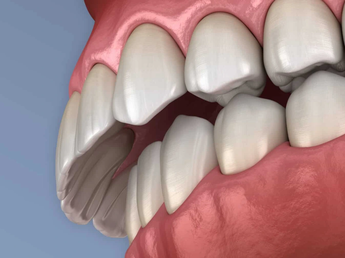 Sobremordida horizontal con separación hacia adelante entre los dientes superiores e inferiores