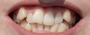 tipos de apiñamiento dental