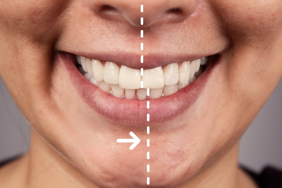 línea media dental desviada