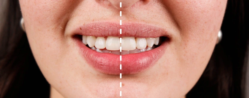 línea media dental desviada
