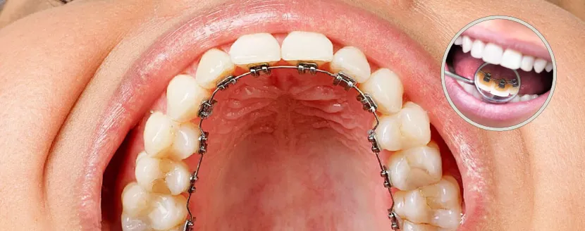 dientes con Brackets linguales