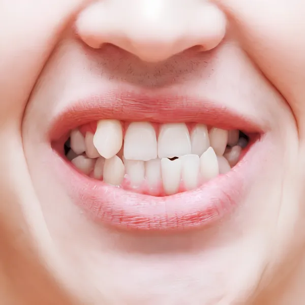 Dientes girados – tratamiento con alineadores invisibles Wire Aligner