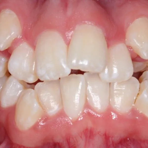 Apiñamiento dental – tratamiento con alineadores invisibles Wire Aligner