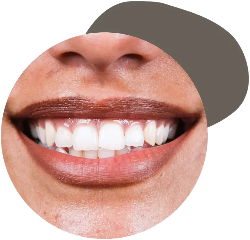 Sonrisa alineada con alineadores invisibles Wire Aligner